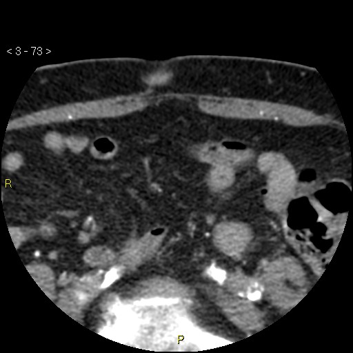 Aortoiliac occlusive disease (Radiopaedia 16828-16548 A 73).jpg