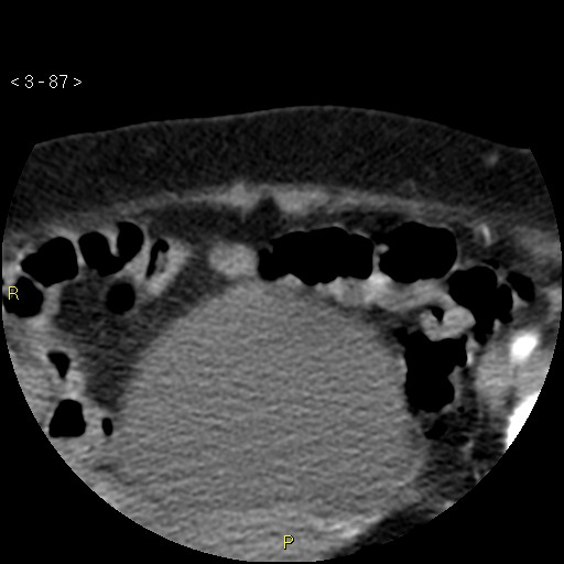 Aortoiliac occlusive disease (Radiopaedia 16828-16548 A 87).jpg