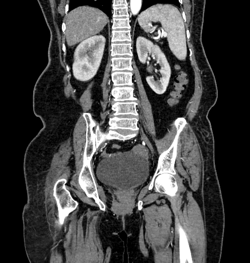 Aortoiliac occlusive disease (Radiopaedia 52352-58248 B 51).jpg