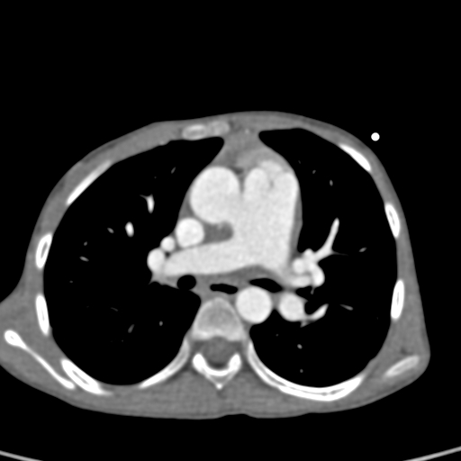 File:Aortopulmonary window, interrupted aortic arch and large PDA giving the descending aorta (Radiopaedia 35573-37074 B 40).jpg