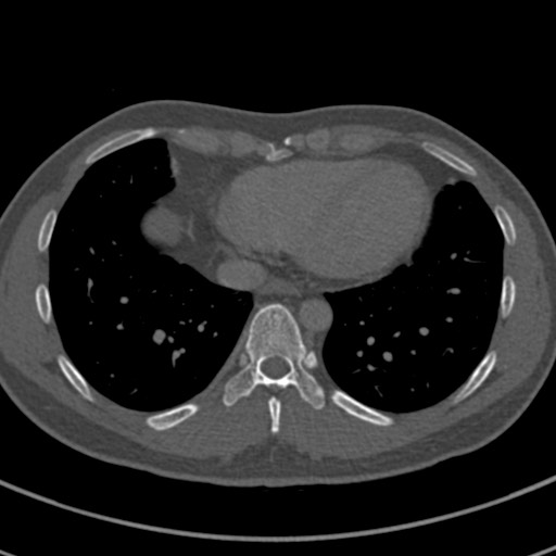 File:Apical lung mass mimic - neurogenic tumor (Radiopaedia 59918-67521 Axial bone window 60).jpg