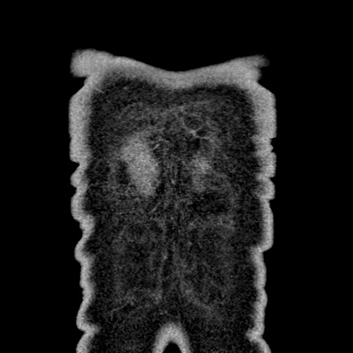 File:Apical lung mass mimic - neurogenic tumor (Radiopaedia 59918-67521 B 108).jpg