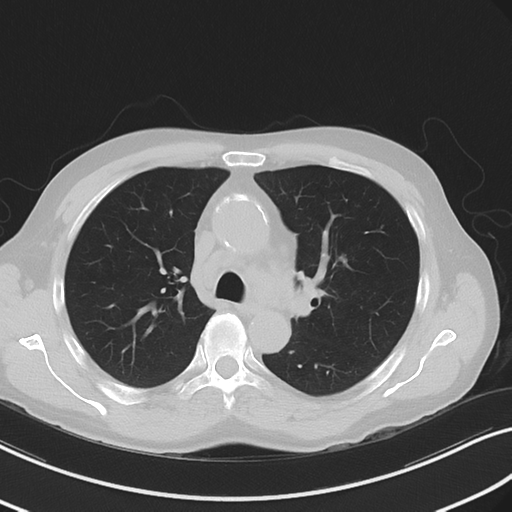 Apical pulmonary metastasis (Radiopaedia 46338-50754 Axial non-contrast 25).png