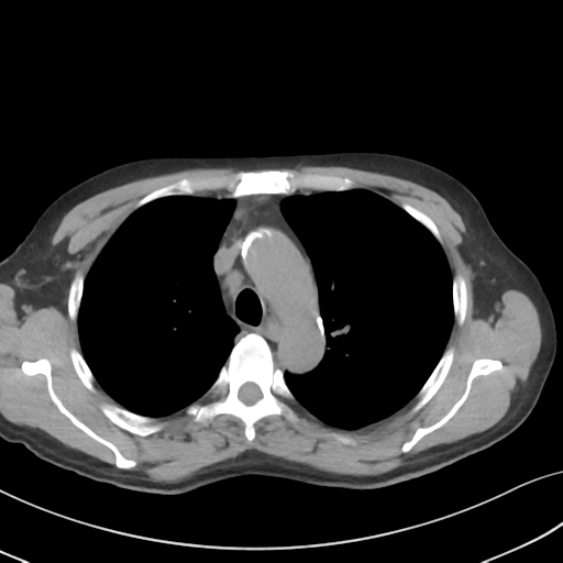 Apical pulmonary metastasis (Radiopaedia 46338-50754 B 21).png