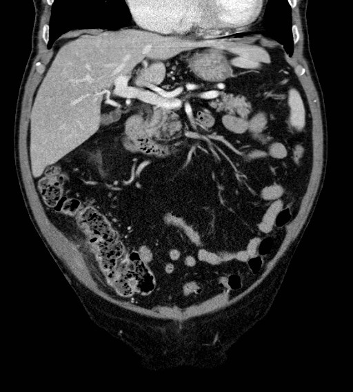 Appendiceal adenocarcinoma complicated by retroperitoneal abscess (Radiopaedia 58007-65039 A 33).jpg