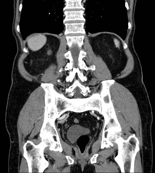 Appendiceal adenocarcinoma complicated by retroperitoneal abscess (Radiopaedia 58007-65039 A 64).jpg