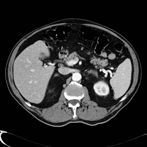 File:Appendiceal adenocarcinoma complicated by retroperitoneal abscess (Radiopaedia 58007-65039 B 46).jpg