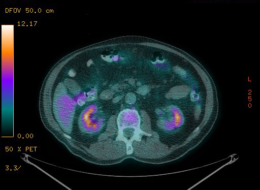Appendiceal adenocarcinoma complicated by retroperitoneal abscess (Radiopaedia 58007-65041 Axial PET-CT 122).jpg