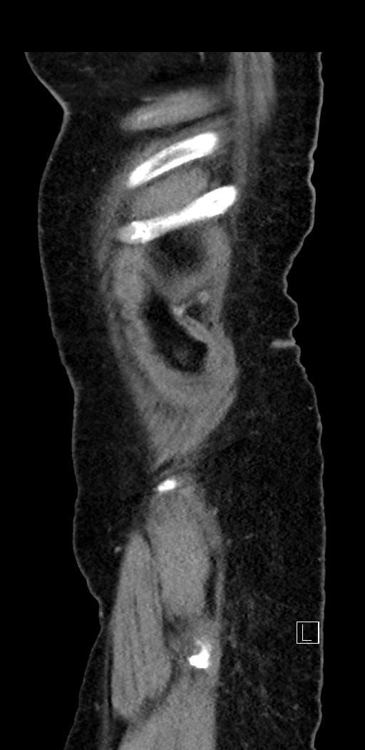 Appendiceal hemorrhage (Radiopaedia 70830-81025 Sagittal C+ delayed 10).jpg