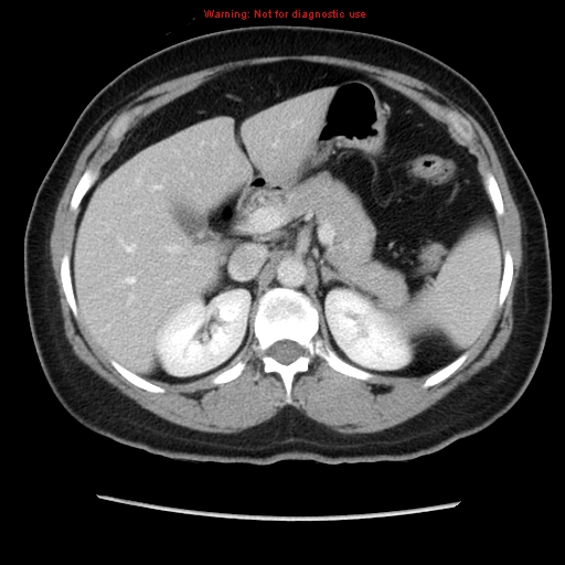 Appendiceal mucinous cystadenoma (Radiopaedia 8263-9111 Axial liver window 27).jpg