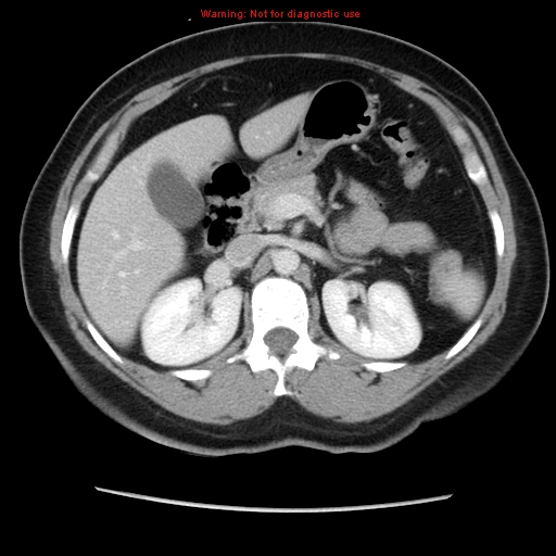 Appendiceal mucinous cystadenoma (Radiopaedia 8263-9111 Axial liver window 30).jpg