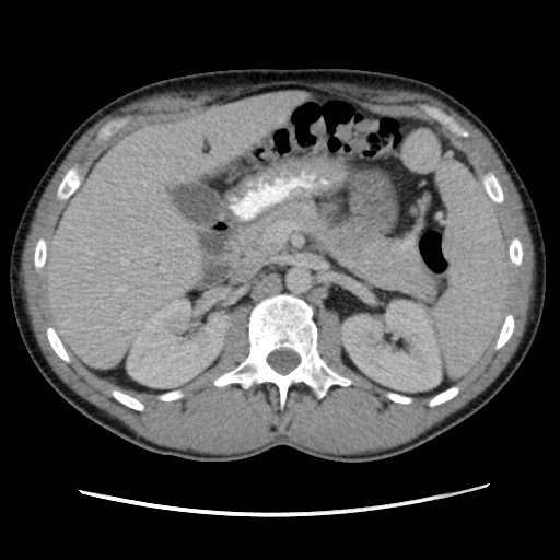File:Appendicitis complicated by post-operative collection (Radiopaedia 35595-37114 A 29).jpg