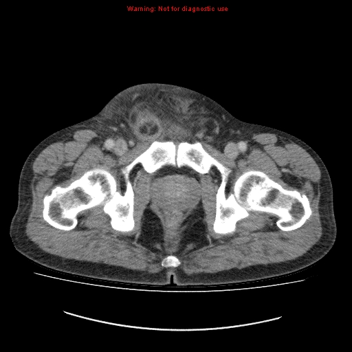 File:Appendicitis mass in inguinal hernia (Radiopaedia 26858-27029 A 30).jpg