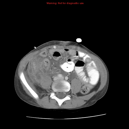 Appendicitis with phlegmon (Radiopaedia 9358-10046 A 46).jpg