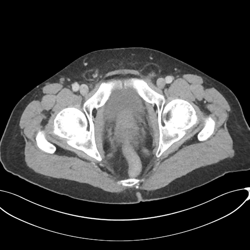 Appendicitis with thickening of the terminal ileum (Radiopaedia 42432-45550 A 93).png