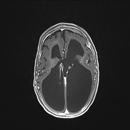Aqueductal stenosis (Radiopaedia 73974-84802 Axial T1 C+ 88).jpg