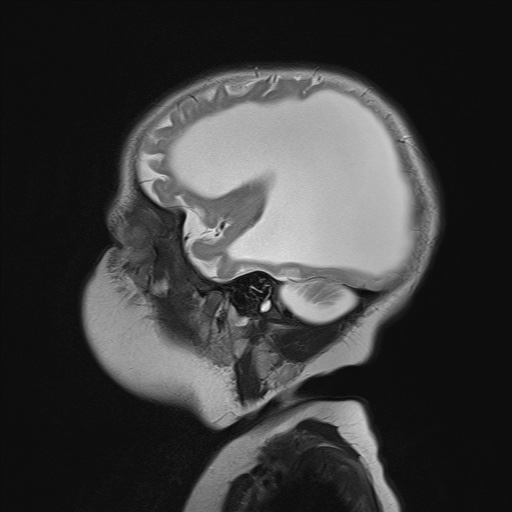 File:Aqueductal stenosis (Radiopaedia 73974-84802 Sagittal T2 19).jpg