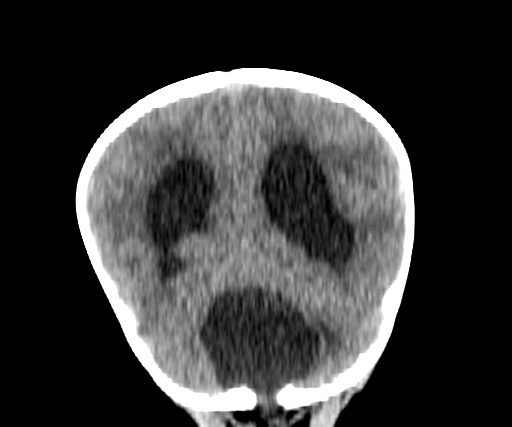 Arachnoid cyst-posterior fossa (Radiopaedia 88661-105370 Coronal non-contrast 57).jpg