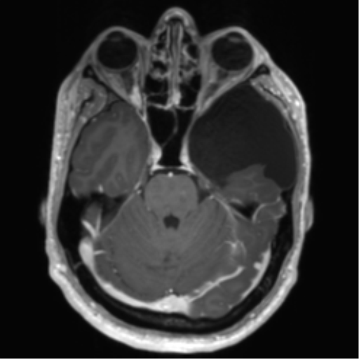 Arachnoid cyst with subdural hematoma (Radiopaedia 85892-101743 Axial T1 C+ 30).png