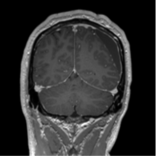Arachnoid cyst with subdural hematoma (Radiopaedia 85892-101743 Coronal T1 C+ 22).png