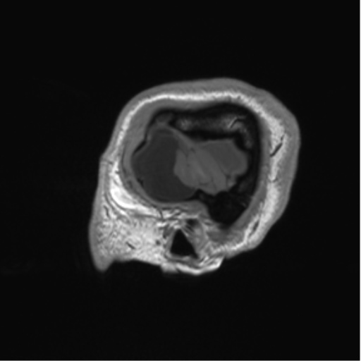 Arachnoid cyst with subdural hematoma (Radiopaedia 85892-101743 Sagittal T1 10).png