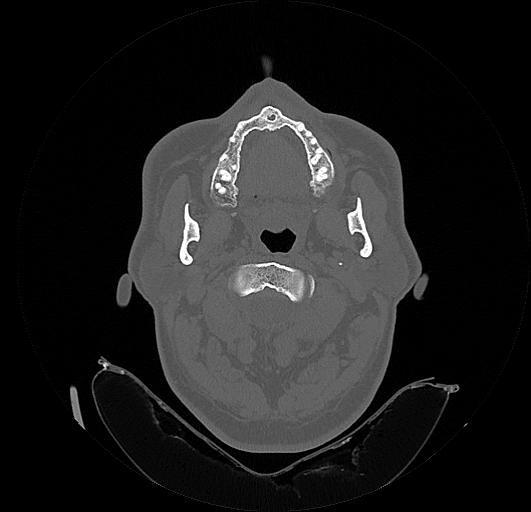 File:Arcuate foramen (Radiopaedia 89833-106944 Axial bone window 44).jpg