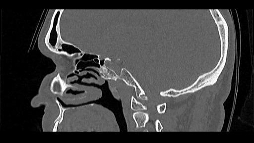 Arcuate foramen (Radiopaedia 89833-106944 Sagittal bone window 77).jpg