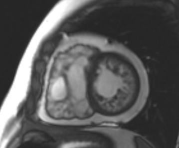 File:Arrhythmogenic right ventricular cardiomyopathy (Radiopaedia 69431-79307 Short axis cine 95).jpg
