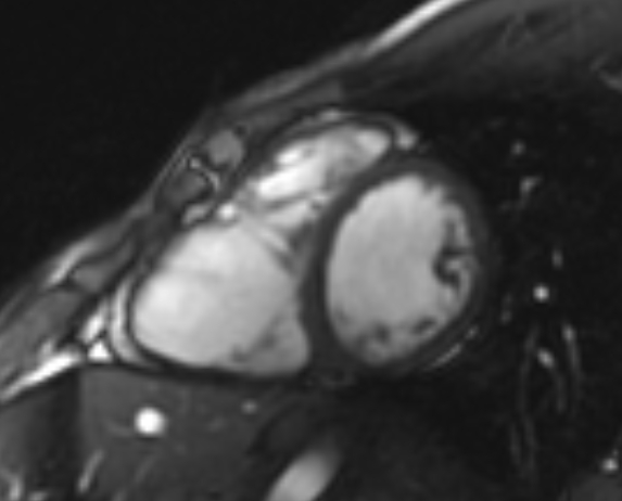 Arrhythmogenic right ventricular cardiomyopathy (Radiopaedia 69564-79464 short axis cine 139).jpg