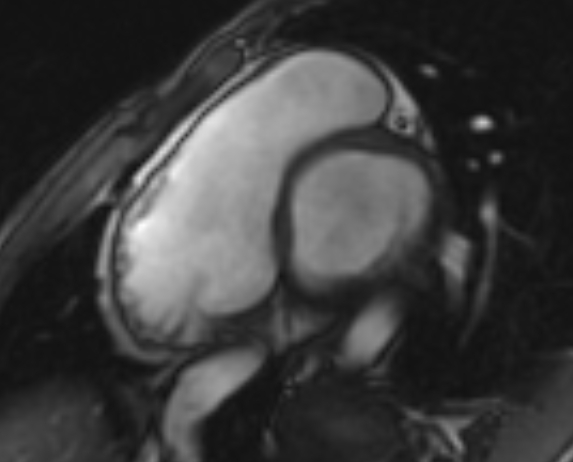 Arrhythmogenic right ventricular cardiomyopathy (Radiopaedia 69564-79464 short axis cine 239).jpg