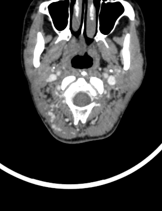 Arteriovenous malformation of the neck (Radiopaedia 53935-60062 B 8).jpg