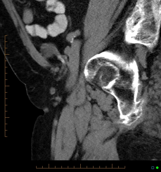 File:Artificial urethral sphincter (Radiopaedia 46937-51464 Sagittal C+ delayed 8).jpg