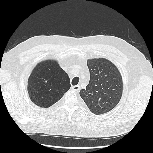 Asbestos-related pleural disease (Radiopaedia 74366-85250 Axial lung window 26).jpg