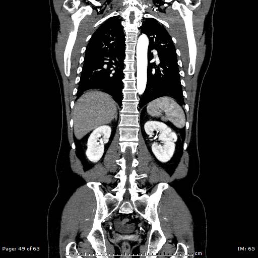 Ascending aortic aneurysm (Radiopaedia 50086-55404 B 49).jpg