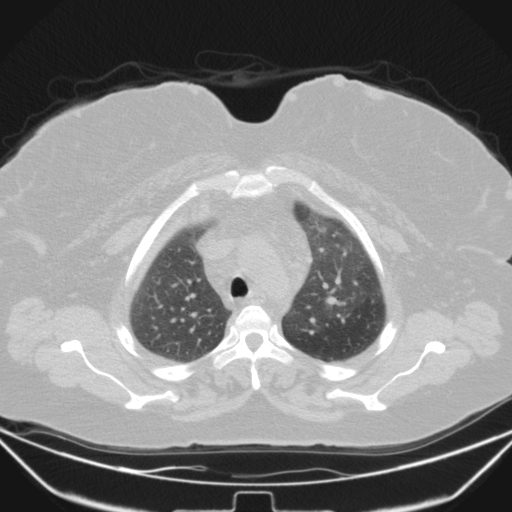 Aspergilloma (Radiopaedia 39611-41932 Axial lung window 26).jpg