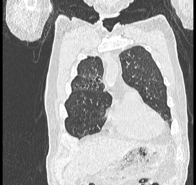 Aspergilloma (Radiopaedia 44592-48327 Coronal lung window 15).jpg