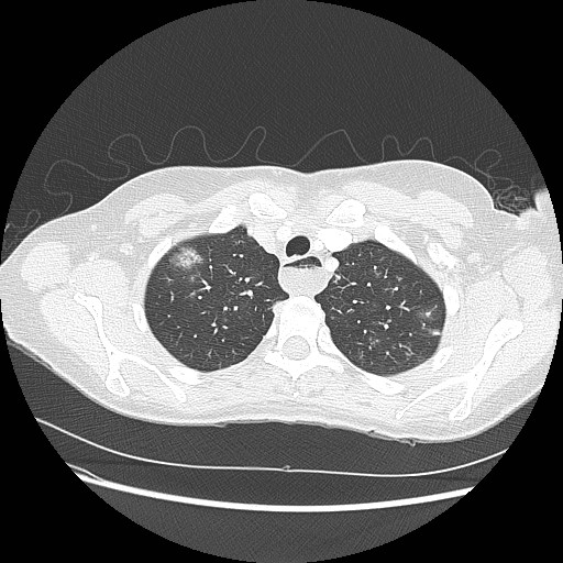 Aspiration pneumonia secondary to laparoscopic banding (Radiopaedia 18345-18183 lung window 17).jpg
