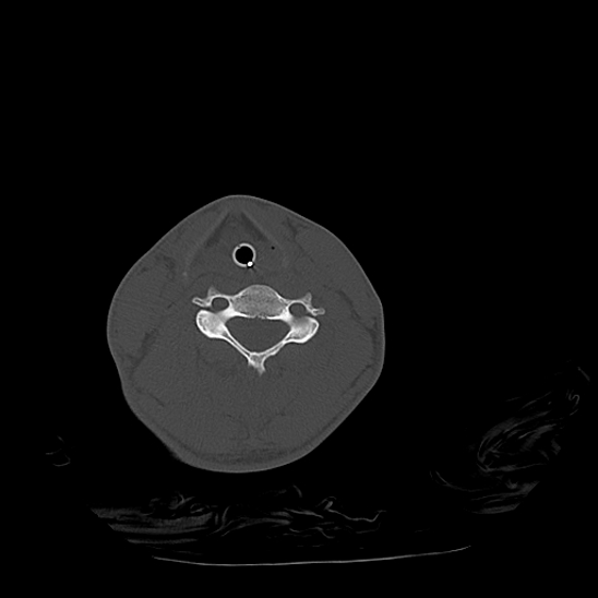 Atlanto-occipital dissociation (Traynelis type 1), C2 teardrop fracture, C6-7 facet joint dislocation (Radiopaedia 87655-104061 Axial bone window 60).jpg