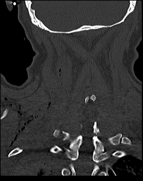 Atlanto-occipital dissociation - Traynelis type 1 (Radiopaedia 87570-103948 Coronal bone window 46).jpg