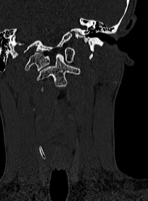 Atlantoaxial subluxation (Radiopaedia 44681-48450 Coronal bone window 14).jpg