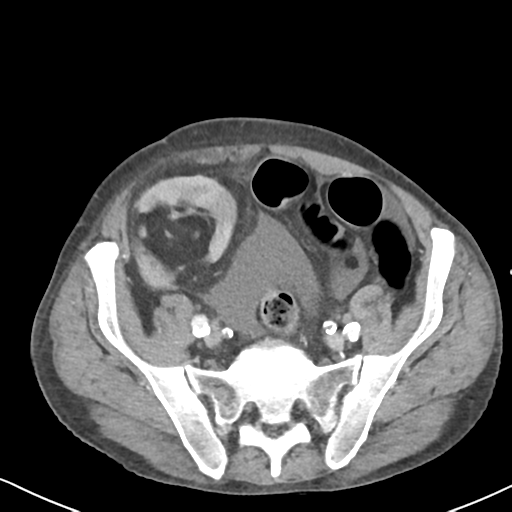 Atraumatic splenic rupture (Radiopaedia 42931-46160 A 65).png