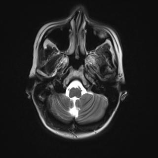 File:Atretic encephalocoele with inferior vermis hypoplasia (Radiopaedia 30443-31108 Axial T2 3).jpg
