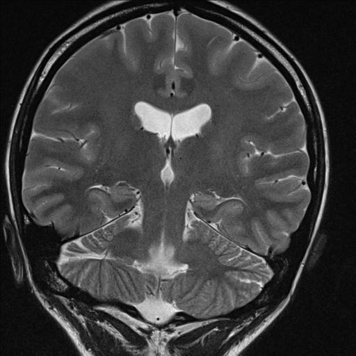 File:Atretic encephalocoele with inferior vermis hypoplasia (Radiopaedia 30443-31108 Coronal T2 3).jpg
