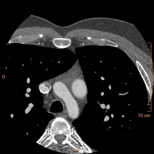 Atrial septal defect (upper sinus venosus type) with partial anomalous pulmonary venous return into superior vena cava (Radiopaedia 73228-83961 A 13).jpg