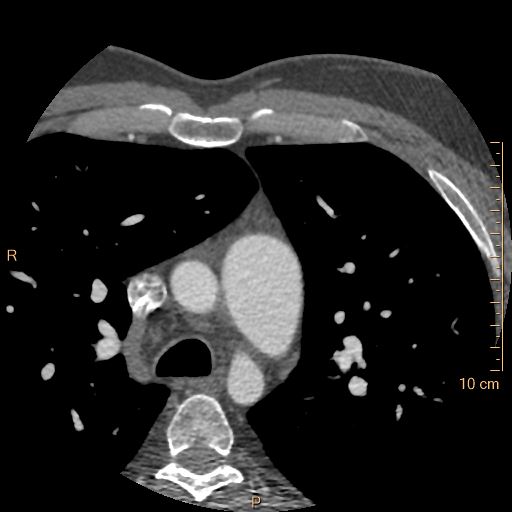 Atrial septal defect (upper sinus venosus type) with partial anomalous pulmonary venous return into superior vena cava (Radiopaedia 73228-83961 A 24).jpg