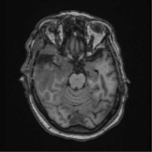 Atypical meningioma (WHO Grade II) (Radiopaedia 54742-60981 Axial T1 25).png