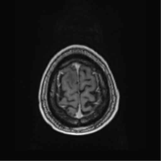 File:Atypical meningioma (WHO grade II) with brain invasion (Radiopaedia 57767-64729 Axial T1 C+ 46).png
