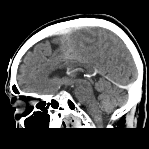 Atypical meningioma (WHO grade II) with osseous invasion (Radiopaedia 53654-59715 G 29).png