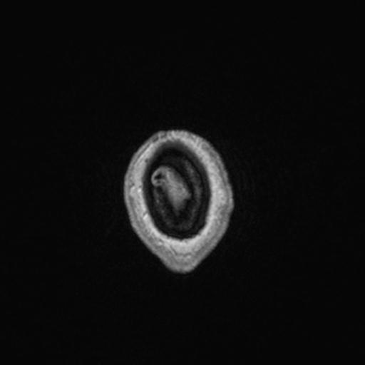 Atypical meningioma (grade II) - en plaque (Radiopaedia 29633-30147 Axial T1 C+ 173).jpg