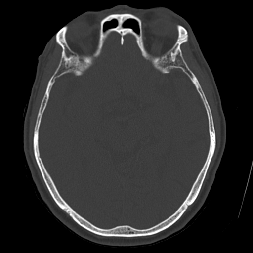 Atypical meningioma with skull invasion (Radiopaedia 34357-35649 Axial bone window 36).png